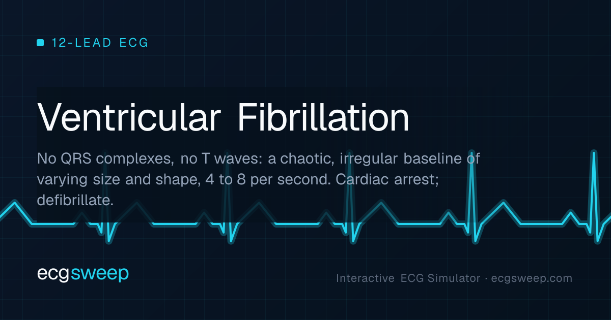 Ventricular Fibrillation: 12-Lead ECG | ECG Sweep