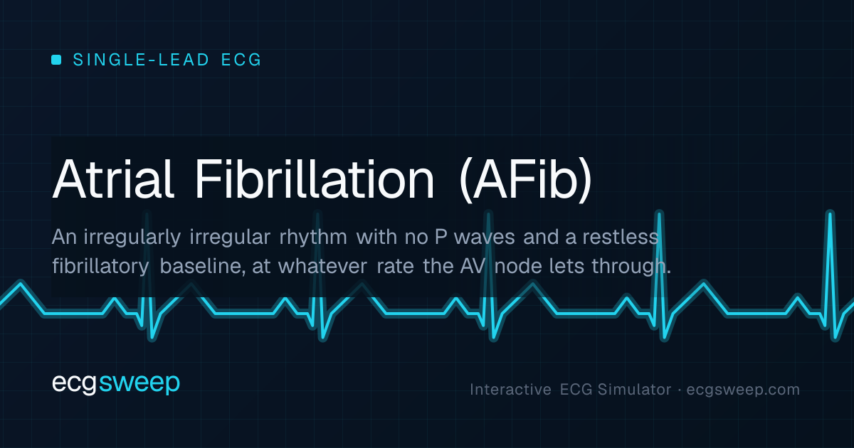 Atrial Fibrillation — ECG on ECG Sweep